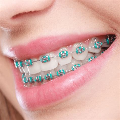 metal brackets teeth|reason for braces on teeth.